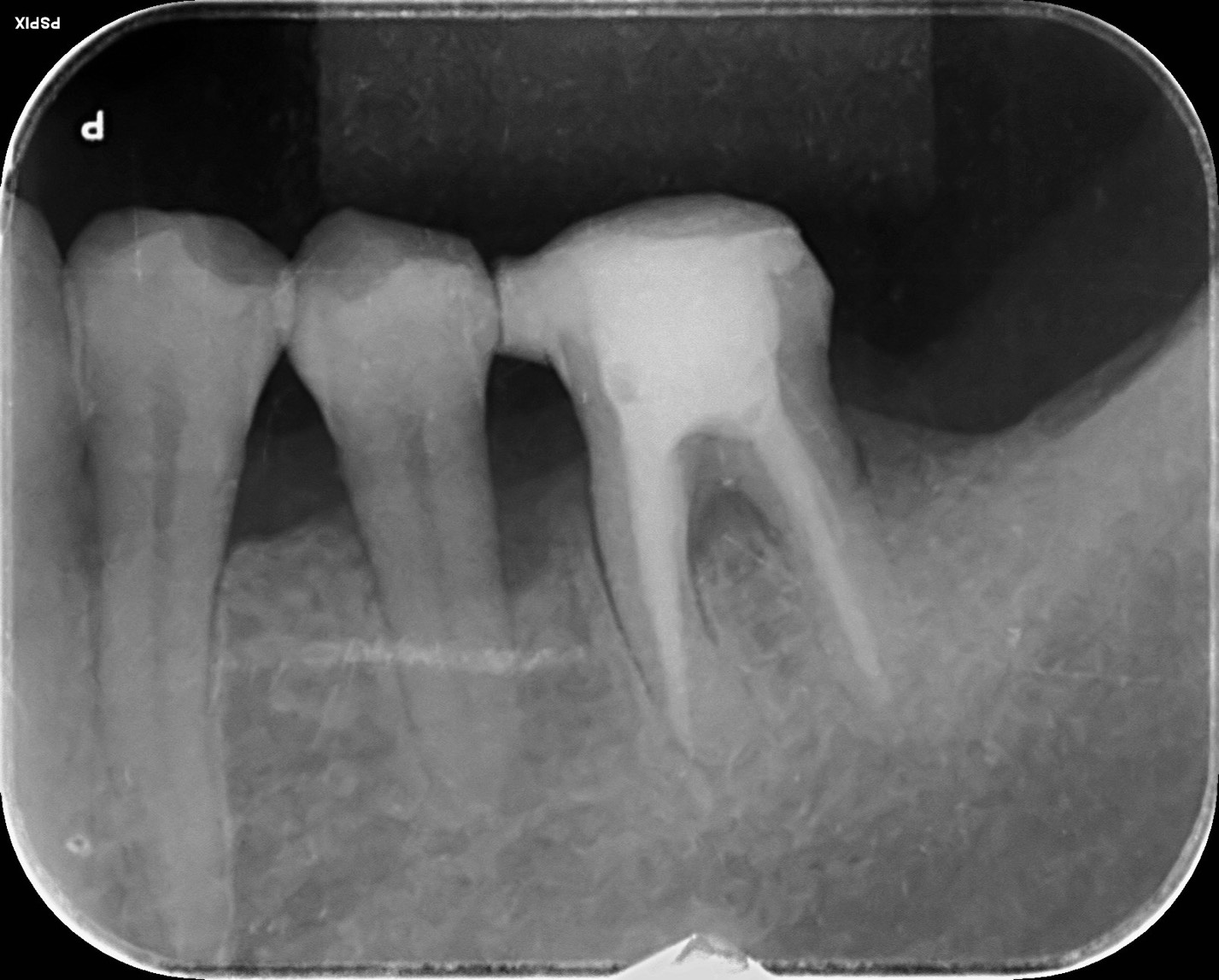 歯周病を非外科