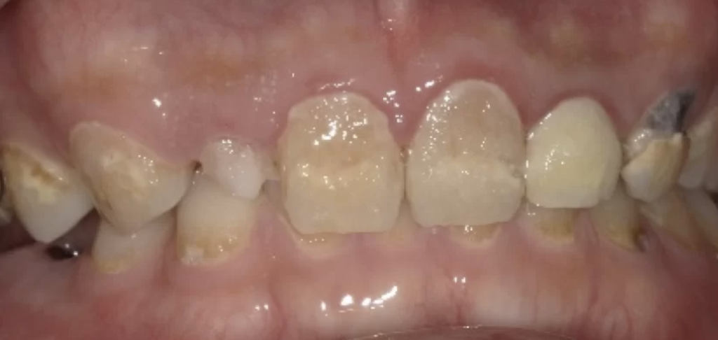 歯科恐怖症治療前