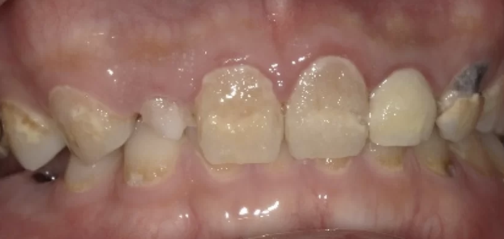 歯科恐怖症術前