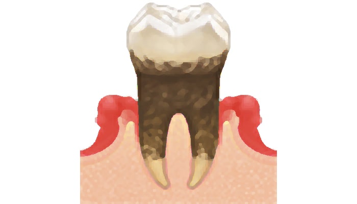 中度歯周炎(4~6mm)